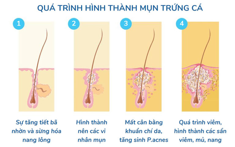 Cách Trị Mụn Trứng Cá đơn Giản